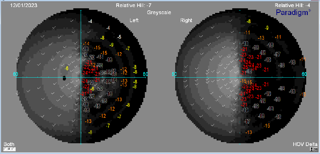 IMAGENHEMIANOPSIA_DERECHA